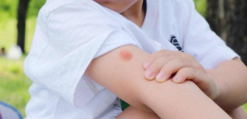 【薬剤師が解説】子供の虫刺され薬の選び方｜かゆみ・腫れ・とびひ予防まで症状別に徹底ガイド